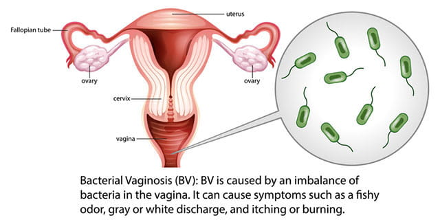 illustration of bacterial vaginosis clearly explaining how it happens