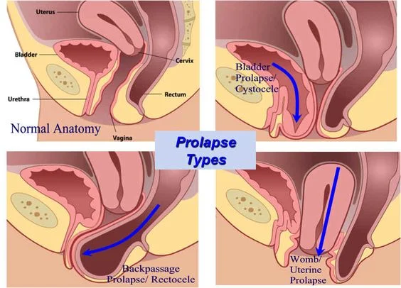 Diagram clearly illustrating the different prolapse types