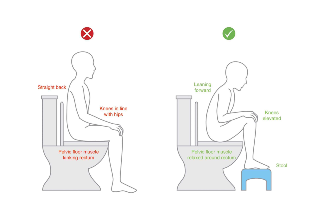 The correct toilet posture to reduce constipation
