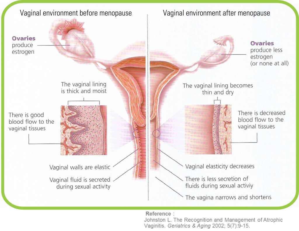 Medical illustration comparing healthy vaginal tissue with atrophic (postmenopausal) vaginal tissue due to estrogen decline